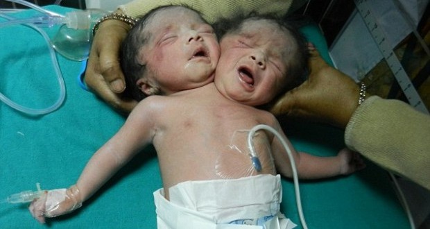 Baby Girl born with two heads in Northern India